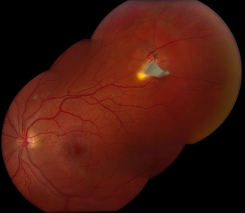 Occult Metallic Intraocular Foreign Body - WINNER JANUARY 2011 - BEST IMAGE
Fundus photograph of a 28 year old male who presented with intermittent, painless, blurred vision of his left eye secondary to an occult metallic intraocular foreign body with old vitreous hemorrhage. He later admitted to feeling a mild gritty sensation of his affected eye while working with a circular saw the previous year. He was then misdiagnosed as having a subconjunctival hemorrhage from the emergency physician. He later underwent successful pars plana vitrectomy and foreign body removal.

