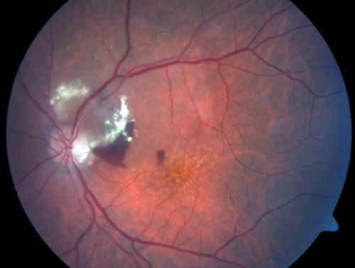 Juxtapapillary CNVM and Serous Macular Detachment Wet AMD Rx Laser
85-year-old man OD is 20/25, OS is 20/100.  IOP:  OD 21, OS 22.  

OS:   Vertical C/D ratio is 0.1.  There is a posterior vitreous separation.  There is a hemorrhagic pigment epithelial detachment on the superior pole of the optic nerve, extending a disc-and-a-half diameter off the nerve, with adjacent exudates.  There is a serous macular detachment involving the center of the fovea.  

VA improved from 20/100 to 20/50 in four months from laser.
Keywords: wet; juxtapapillary;laser;amd;serous;detachment