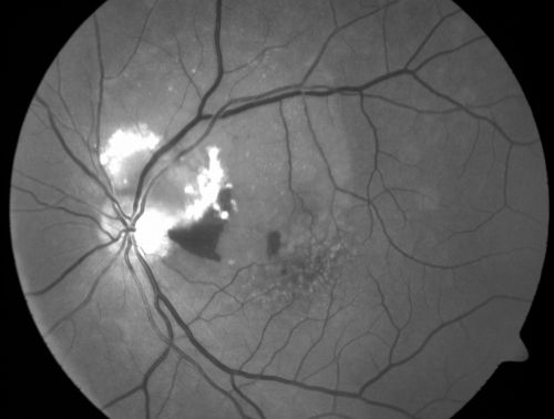 Juxtapapillary CNVM and Serous Macular Detachment Wet AMD Rx Laser
85-year-old man OD is 20/25, OS is 20/100.  IOP:  OD 21, OS 22.  

OS:   Vertical C/D ratio is 0.1.  There is a posterior vitreous separation.  There is a hemorrhagic pigment epithelial detachment on the superior pole of the optic nerve, extending a disc-and-a-half diameter off the nerve, with adjacent exudates.  There is a serous macular detachment involving the center of the fovea.  

VA improved from 20/100 to 20/50 in four months from laser.
Keywords: wet; juxtapapillary;laser;amd;serous;detachment