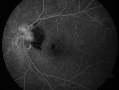 Juxtapapillary CNVM and Serous Macular Detachment Wet AMD Rx Laser
85-year-old man OD is 20/25, OS is 20/100.  IOP:  OD 21, OS 22.  

OS:   Vertical C/D ratio is 0.1.  There is a posterior vitreous separation.  There is a hemorrhagic pigment epithelial detachment on the superior pole of the optic nerve, extending a disc-and-a-half diameter off the nerve, with adjacent exudates.  There is a serous macular detachment involving the center of the fovea.  

VA improved from 20/100 to 20/50 in four months from laser.
Mots-clés: wet; juxtapapillary;laser;amd;serous;detachment