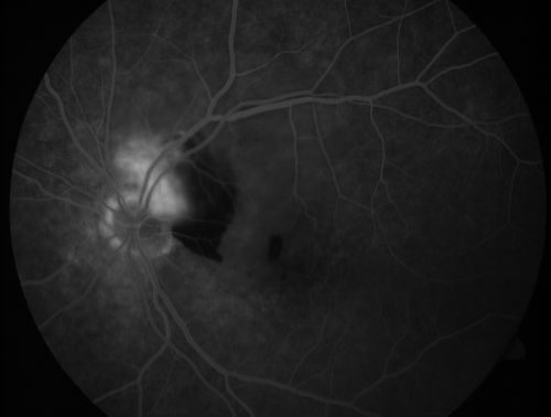 Juxtapapillary CNVM and Serous Macular Detachment Wet AMD Rx Laser
85-year-old man OD is 20/25, OS is 20/100.  IOP:  OD 21, OS 22.  

OS:   Vertical C/D ratio is 0.1.  There is a posterior vitreous separation.  There is a hemorrhagic pigment epithelial detachment on the superior pole of the optic nerve, extending a disc-and-a-half diameter off the nerve, with adjacent exudates.  There is a serous macular detachment involving the center of the fovea.  

VA improved from 20/100 to 20/50 in four months from laser.
Mots-clés: wet; juxtapapillary;laser;amd;serous;detachment