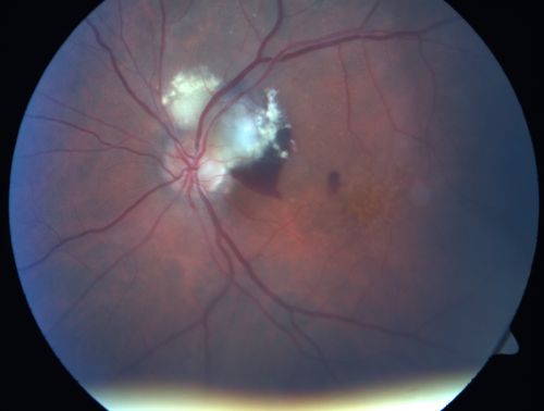 Juxtapapillary CNVM and Serous Macular Detachment Wet AMD Rx Laser
85-year-old man OD is 20/25, OS is 20/100.  IOP:  OD 21, OS 22.  

OS:   Vertical C/D ratio is 0.1.  There is a posterior vitreous separation.  There is a hemorrhagic pigment epithelial detachment on the superior pole of the optic nerve, extending a disc-and-a-half diameter off the nerve, with adjacent exudates.  There is a serous macular detachment involving the center of the fovea.  

VA improved from 20/100 to 20/50 in four months from laser.
Schlüsselwörter: wet; juxtapapillary;laser;amd;serous;detachment