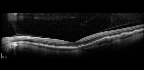 Late Onset Retinal Degeneration (L-ORD)
55 year old with acute vision loss from a CNVM in the right eye.  He responded to Lucentis therapy.  His mother and her family has been confirmed genetically to have L-ORD and were part of the early reports.
