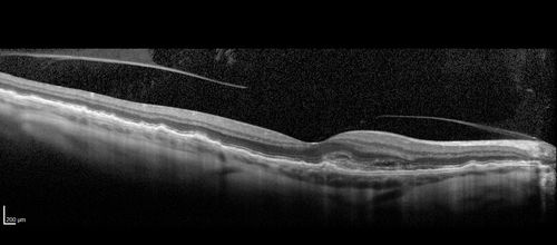 Late Onset Retinal Degeneration (L-ORD)
55 year old with acute vision loss from a CNVM in the right eye.  He responded to Lucentis therapy.  His mother and her family has been confirmed genetically to have L-ORD and were part of the early reports.
