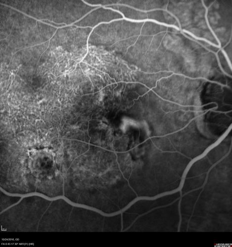 Late Onset Retinal Degeneration (L-ORD)
55 year old with acute vision loss from a CNVM in the right eye.  He responded to Lucentis therapy.  His mother and her family has been confirmed genetically to have L-ORD and were part of the early reports.
