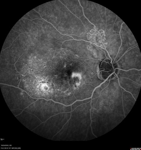Late Onset Retinal Degeneration (L-ORD)
55 year old with acute vision loss from a CNVM in the right eye.  He responded to Lucentis therapy.  His mother and her family has been confirmed genetically to have L-ORD and were part of the early reports.
