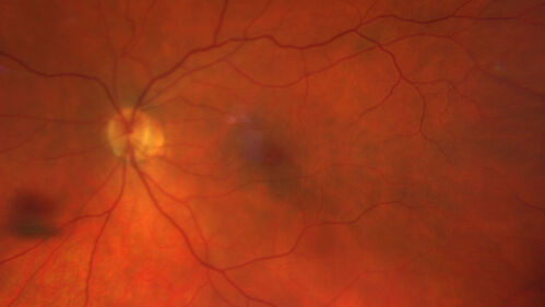 Lamellar Macular Hole and Good Vision
67 year old woman with good vision and floaters - VA 20/32 OD, 20/23 OS
