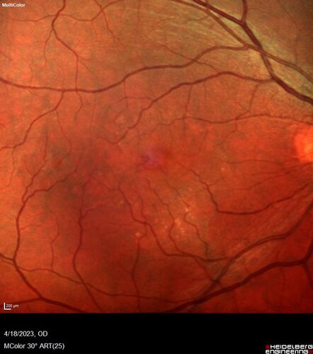 Lamellar Macular Hole and Good Vision
67 year old woman with good vision and floaters - VA 20/32 OD, 20/23 OS
