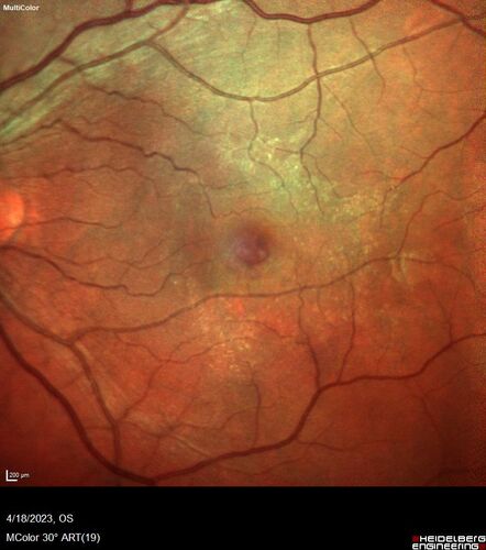 Lamellar Macular Hole and Good Vision
67 year old woman with good vision and floaters - VA 20/32 OD, 20/23 OS
