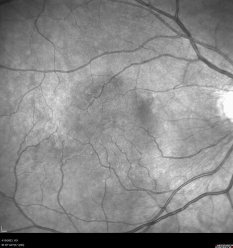 Lamellar Macular Hole and Good Vision
67 year old woman with good vision and floaters - VA 20/32 OD, 20/23 OS

