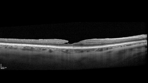 Lamellar Macular Hole and Good Vision
67 year old woman with good vision and floaters - VA 20/32 OD, 20/23 OS
