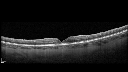 Lamellar Macular Hole and Good Vision
67 year old woman with good vision and floaters - VA 20/32 OD, 20/23 OS

