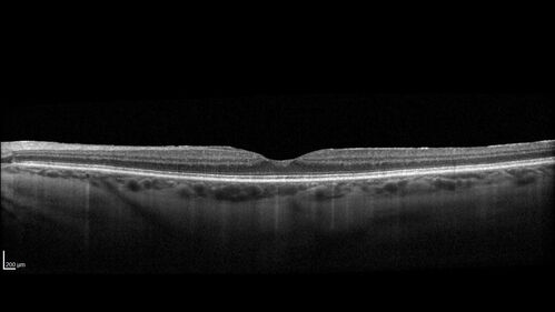 Lamellar Macular Hole and Good Vision
67 year old woman with good vision and floaters - VA 20/32 OD, 20/23 OS
