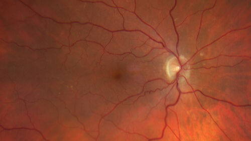 Ruptured Retinal Arterial Macroaneurysm - Submacular hemorrhage and BRAO
81 year old female with vision loss for a few days.  Coumadin was high with INR at 3.1 VA 6/200
