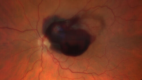 Ruptured Retinal Arterial Macroaneurysm - Submacular hemorrhage and BRAO
81 year old female with vision loss for a few days.  Coumadin was high with INR at 3.1 VA 6/200

