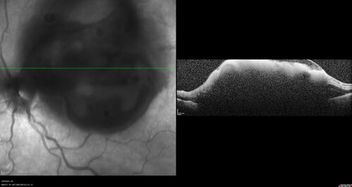 Ruptured Retinal Arterial Macroaneurysm - Submacular hemorrhage and BRAO
81 year old female with vision loss for a few days.  Coumadin was high with INR at 3.1 VA 6/200
