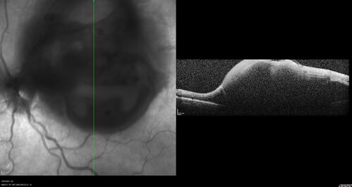 Ruptured Retinal Arterial Macroaneurysm - Submacular hemorrhage and BRAO
81 year old female with vision loss for a few days.  Coumadin was high with INR at 3.1 VA 6/200

