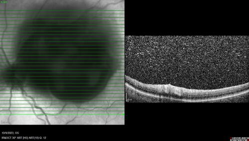 Ruptured Retinal Arterial Macroaneurysm - Submacular hemorrhage and BRAO
81 year old female with vision loss for a few days.  Coumadin was high with INR at 3.1 VA 6/200
