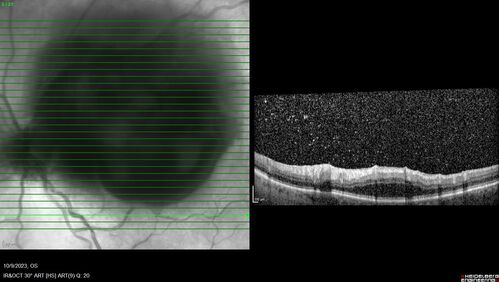 Ruptured Retinal Arterial Macroaneurysm - Submacular hemorrhage and BRAO
81 year old female with vision loss for a few days.  Coumadin was high with INR at 3.1 VA 6/200
