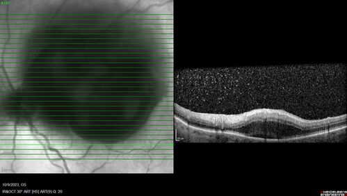 Ruptured Retinal Arterial Macroaneurysm - Submacular hemorrhage and BRAO
81 year old female with vision loss for a few days.  Coumadin was high with INR at 3.1 VA 6/200
