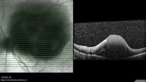 Ruptured Retinal Arterial Macroaneurysm - Submacular hemorrhage and BRAO
81 year old female with vision loss for a few days.  Coumadin was high with INR at 3.1 VA 6/200

