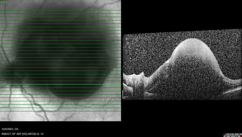 Ruptured Retinal Arterial Macroaneurysm - Submacular hemorrhage and BRAO
81 year old female with vision loss for a few days.  Coumadin was high with INR at 3.1 VA 6/200
