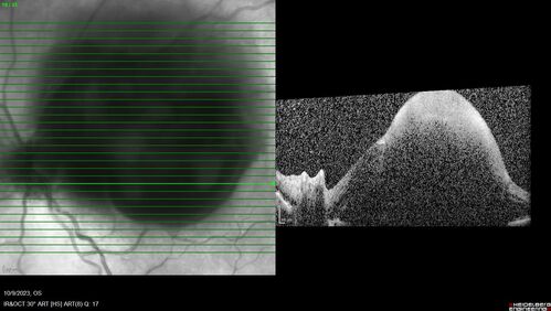 Ruptured Retinal Arterial Macroaneurysm - Submacular hemorrhage and BRAO
81 year old female with vision loss for a few days.  Coumadin was high with INR at 3.1 VA 6/200
