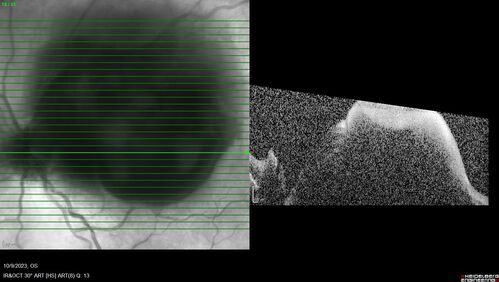 Ruptured Retinal Arterial Macroaneurysm - Submacular hemorrhage and BRAO
81 year old female with vision loss for a few days.  Coumadin was high with INR at 3.1 VA 6/200
