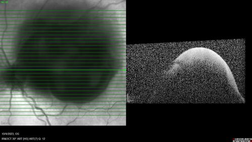 Ruptured Retinal Arterial Macroaneurysm - Submacular hemorrhage and BRAO
81 year old female with vision loss for a few days.  Coumadin was high with INR at 3.1 VA 6/200
