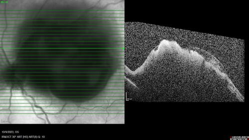 Ruptured Retinal Arterial Macroaneurysm - Submacular hemorrhage and BRAO
81 year old female with vision loss for a few days.  Coumadin was high with INR at 3.1 VA 6/200

