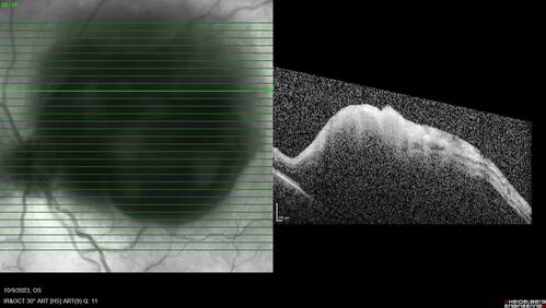 Ruptured Retinal Arterial Macroaneurysm - Submacular hemorrhage and BRAO
81 year old female with vision loss for a few days.  Coumadin was high with INR at 3.1 VA 6/200
