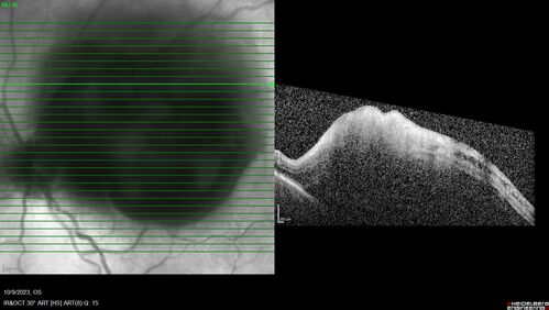 Ruptured Retinal Arterial Macroaneurysm - Submacular hemorrhage and BRAO
81 year old female with vision loss for a few days.  Coumadin was high with INR at 3.1 VA 6/200
