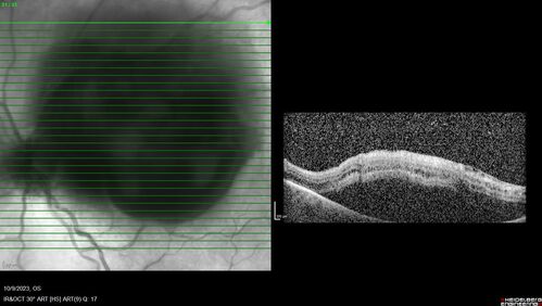 Ruptured Retinal Arterial Macroaneurysm - Submacular hemorrhage and BRAO
81 year old female with vision loss for a few days.  Coumadin was high with INR at 3.1 VA 6/200
