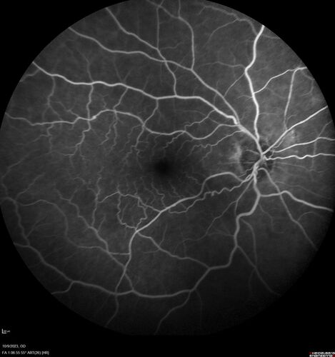 Ruptured Retinal Arterial Macroaneurysm - Submacular hemorrhage and BRAO
81 year old female with vision loss for a few days.  Coumadin was high with INR at 3.1 VA 6/200
