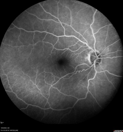 Ruptured Retinal Arterial Macroaneurysm - Submacular hemorrhage and BRAO
81 year old female with vision loss for a few days.  Coumadin was high with INR at 3.1 VA 6/200

