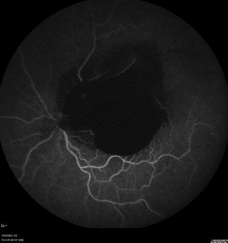 Ruptured Retinal Arterial Macroaneurysm - Submacular hemorrhage and BRAO
81 year old female with vision loss for a few days.  Coumadin was high with INR at 3.1 VA 6/200

