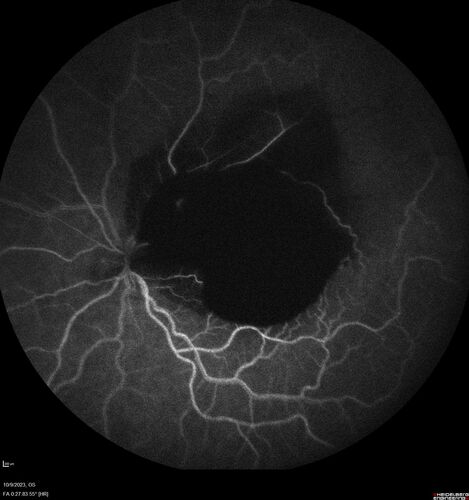 Ruptured Retinal Arterial Macroaneurysm - Submacular hemorrhage and BRAO
81 year old female with vision loss for a few days.  Coumadin was high with INR at 3.1 VA 6/200
