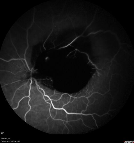 Ruptured Retinal Arterial Macroaneurysm - Submacular hemorrhage and BRAO
81 year old female with vision loss for a few days.  Coumadin was high with INR at 3.1 VA 6/200
