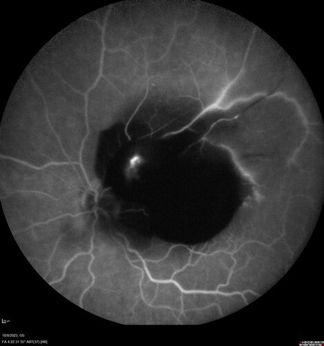 Ruptured Retinal Arterial Macroaneurysm - Submacular hemorrhage and BRAO
81 year old female with vision loss for a few days.  Coumadin was high with INR at 3.1 VA 6/200

