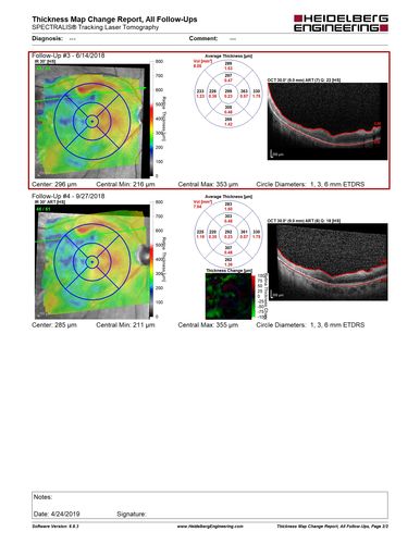 Hyperpigmented Vasoproliferative Tumor on Buckle with New Serous Retinal Detachment 20 years post RD Repair
67 year old female RD repair OU 1999 then severe (20/400) macular pucker OD removed 3 months later (twin sister also had bilateral RDâ€™s with PVR).  Then dislocated IOL surgery right eye 9/2012.  New vision loss in the right eye with serous retinal detachment.  Argon laser to dark tumor led to resolution of subretinal fluid within a month.
