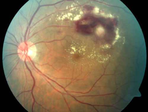 Retinal Arterial Macroaneurysm - Untreated Hypertension (250/135) - Serous Macular Detachment 
82 year old asian woman.  VA 20/80 Headaches and vision loss for 1 month.  Negative medical history but has not been to the doctor for years. (no insurance)
