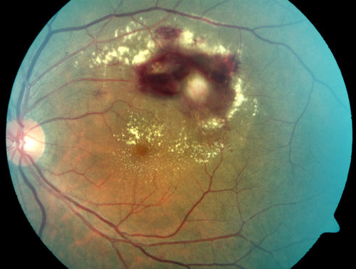 Retinal Arterial Macroaneurysm - Untreated Hypertension (250/135) - Serous Macular Detachment
82 year old asian woman.  VA 20/80 Headaches and vision loss for 1 month.  Negative medical history but has not been to the doctor for years. (no insurance)
