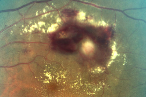 Retinal Arterial Macroaneurysm - Untreated Hypertension (250/135) - Serous Macular Detachment
82 year old asian woman.  VA 20/80 Headaches and vision loss for 1 month.  Negative medical history but has not been to the doctor for years. (no insurance)
