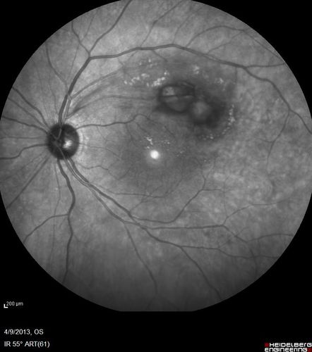 Retinal Arterial Macroaneurysm - Untreated Hypertension (250/135) - Serous Macular Detachment
82 year old asian woman.  VA 20/80 Headaches and vision loss for 1 month.  Negative medical history but has not been to the doctor for years. (no insurance)
