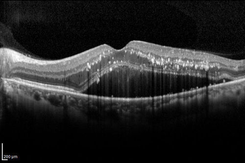 Retinal Arterial Macroaneurysm - Untreated Hypertension (250/135) - Serous Macular Detachment
82 year old asian woman.  VA 20/80 Headaches and vision loss for 1 month.  Negative medical history but has not been to the doctor for years. (no insurance)
