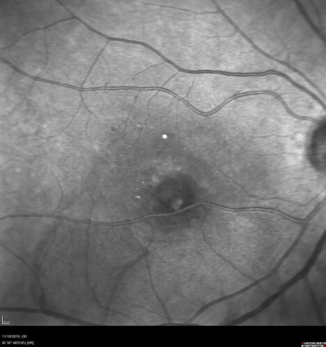 Retinal Arterial Macroaneursym
69 year old female with vision loss for a few months in the right eye.  Images show a macroaneurysm in the right eye.  The lesion had bled and FA showed no leakage.  No treatment was done.  VA improved from 20/40 - 20/32

