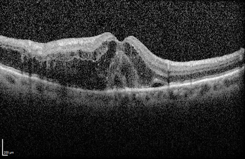 Self Sealed Retinal Arteriol Macroaneurysm
SD OCT line scan with intraretinal fluid
