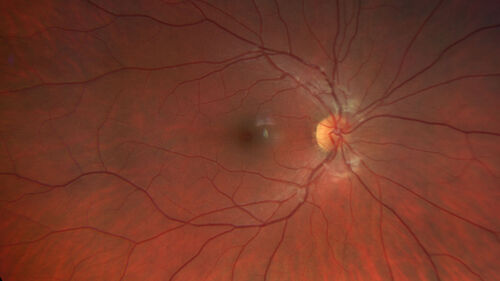 Multiple Evanescent White Dot Syndrome - MEWDS Left Eye
22 year old man with good vision but blind spot in the left eye for a week.  No viral prodrome or vaccination.  VA 20/15 OD, 20/20 OS

