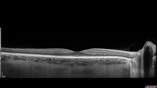 Multiple Evanescent White Dot Syndrome - MEWDS Left Eye
22 year old man with good vision but blind spot in the left eye for a week.  No viral prodrome or vaccination.  VA 20/15 OD, 20/20 OS
