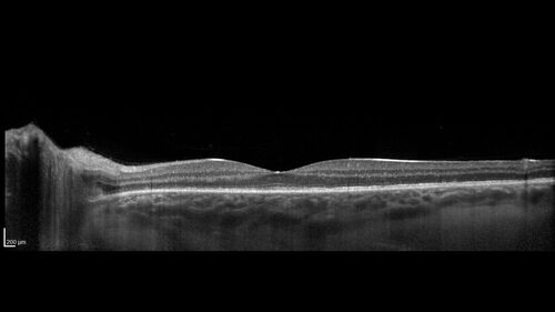 Multiple Evanescent White Dot Syndrome - MEWDS Left Eye
22 year old man with good vision but blind spot in the left eye for a week.  No viral prodrome or vaccination.  VA 20/15 OD, 20/20 OS
